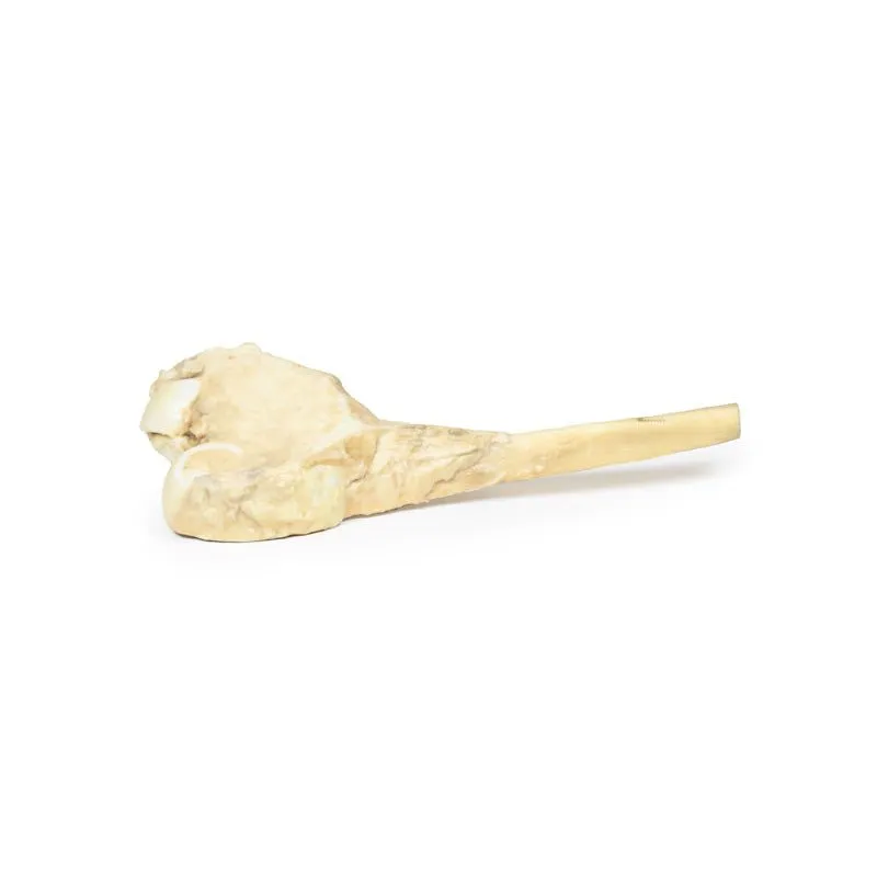 3D Printed Osteosarcoma of Femur