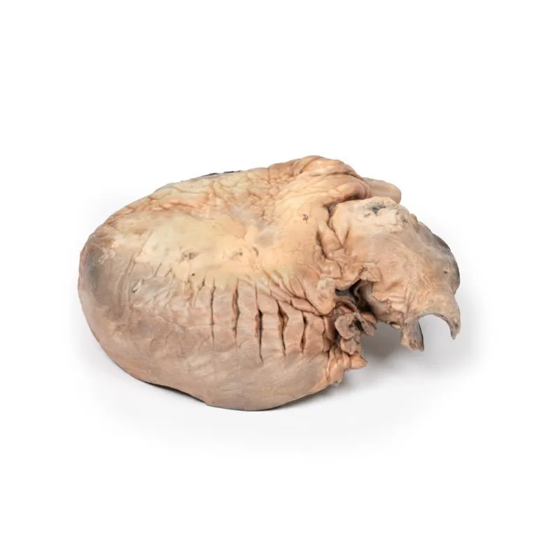 3D Printed Ruptured Thoracic Aortic Aneurysm