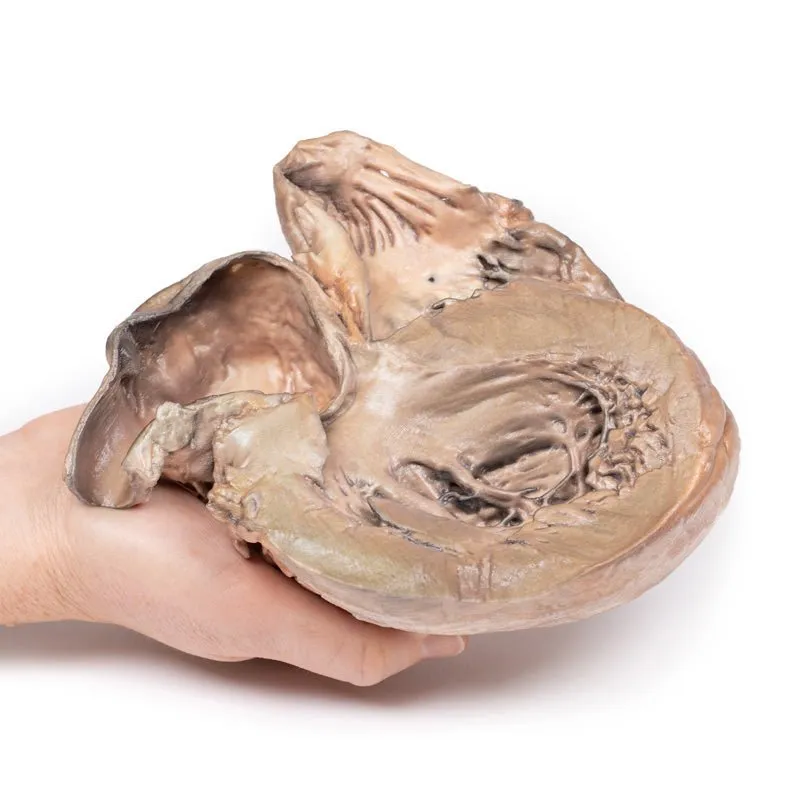 3D Printed Ruptured Thoracic Aortic Aneurysm
