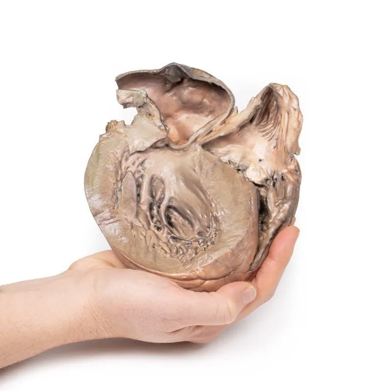 3D Printed Ruptured Thoracic Aortic Aneurysm