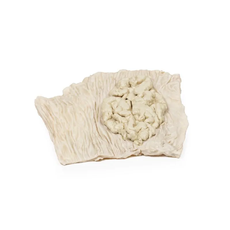 3D Printed Villous Adenoma of Colon