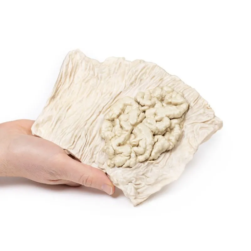 3D Printed Villous Adenoma of Colon