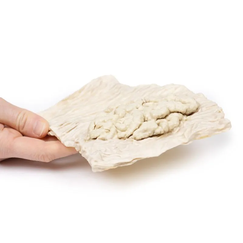 3D Printed Villous Adenoma of Colon